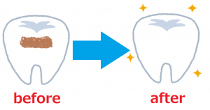 歯白くする,歯白く,自宅,自分,セルフ,消しゴム,黄ばみ,付着,白く,歯,100均,方法,歯を白くする方法
