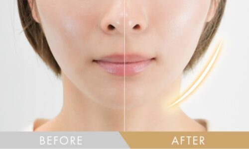 NIPLUX(ニップラックス) BEGUN効果